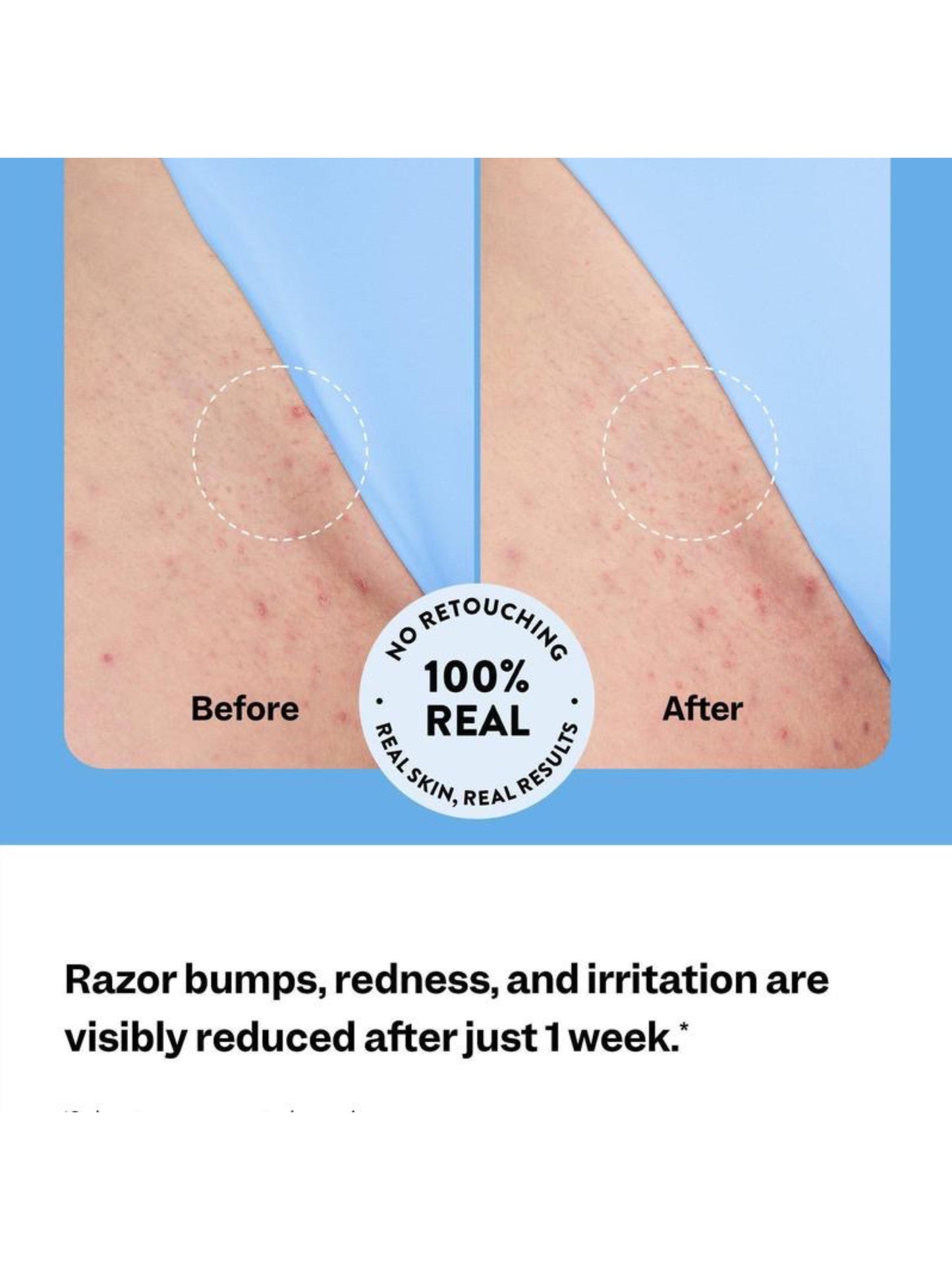 Eloa™ Ingrown Hair Treatment